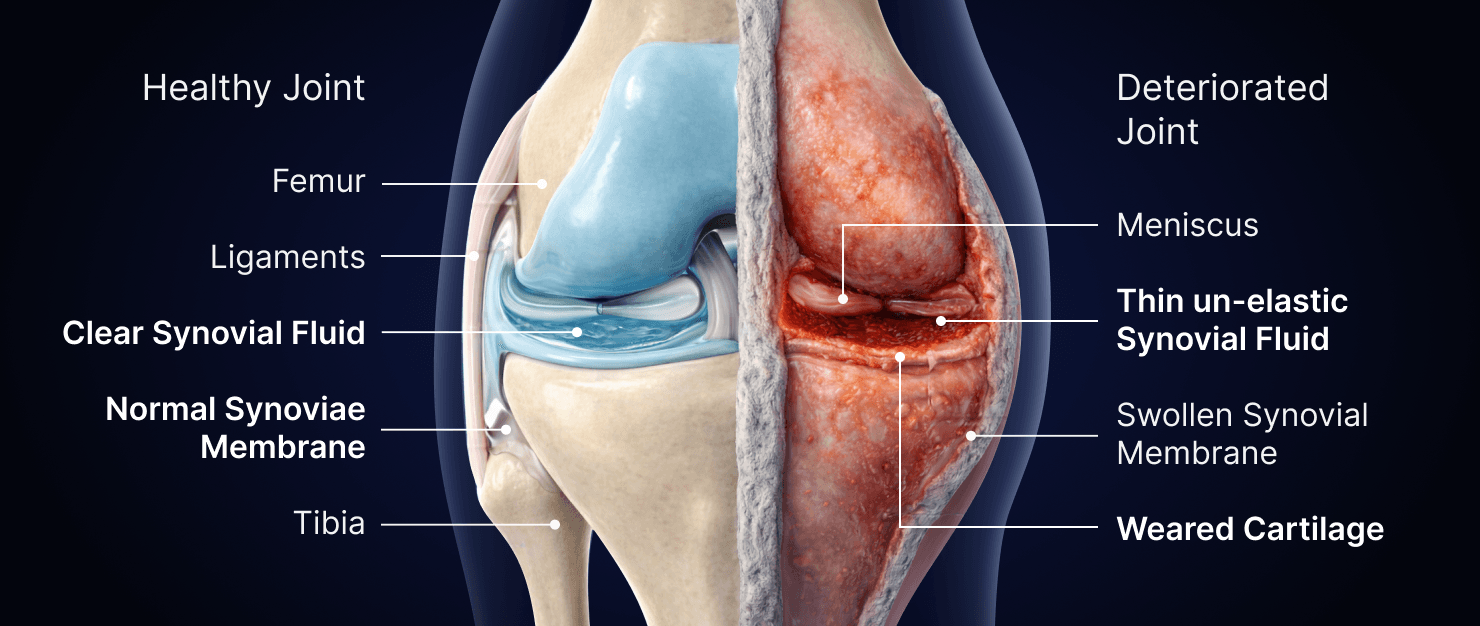 Anatomical knee, cross section diagram showing a healthy joint with clear synovial fluid and normal synovial membrane, versus a deteriorated joint with thin synovial membrane (deteriorated properties, lower elasticity) and an irregular cartilage surface.